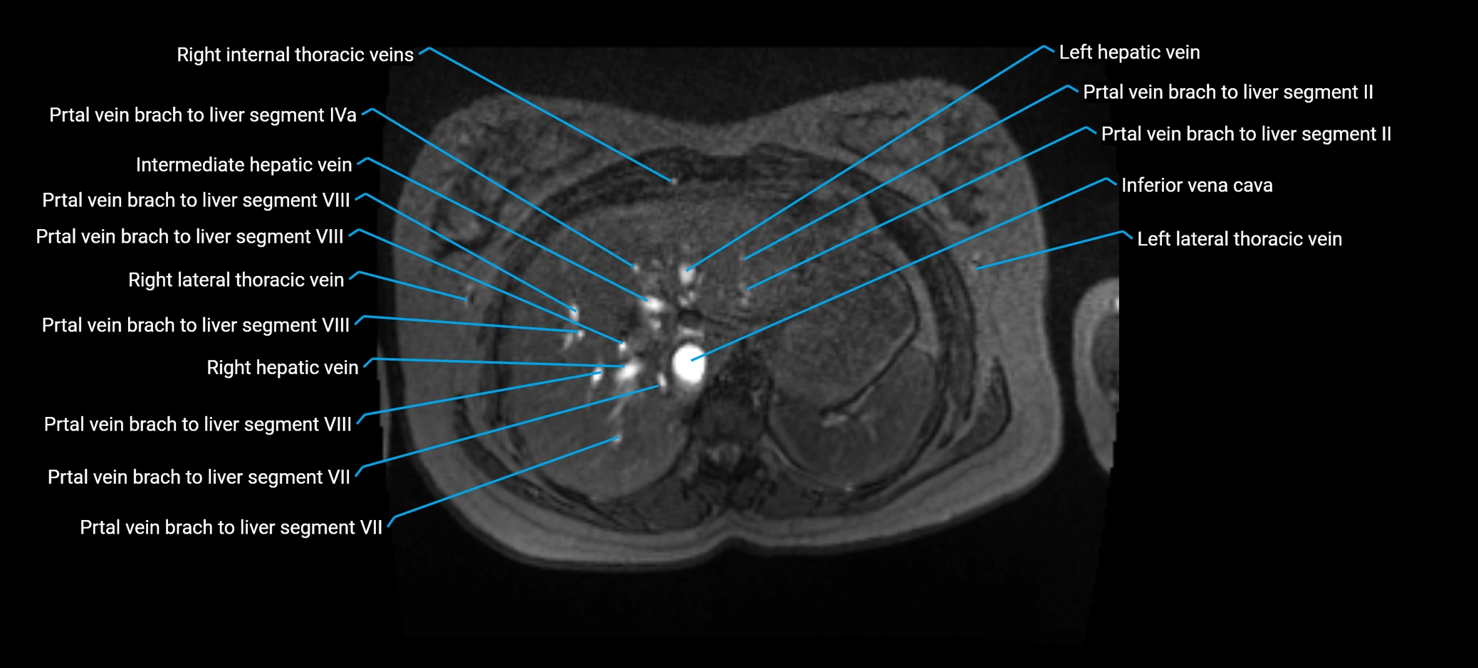MRV abdomen pelvis & lower limb axial cross sectional anatomy labelled MRI image 26 (2).webp